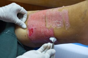 3rd degree burns with needed skin grafts are common in fire pit burn accidents